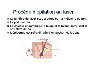 épilation laser